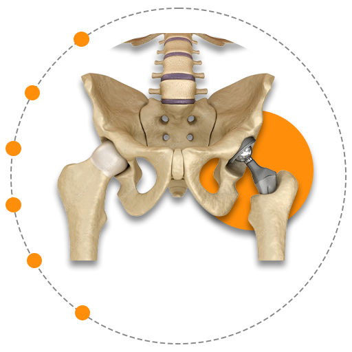 Joint Replacement & Sports Injury