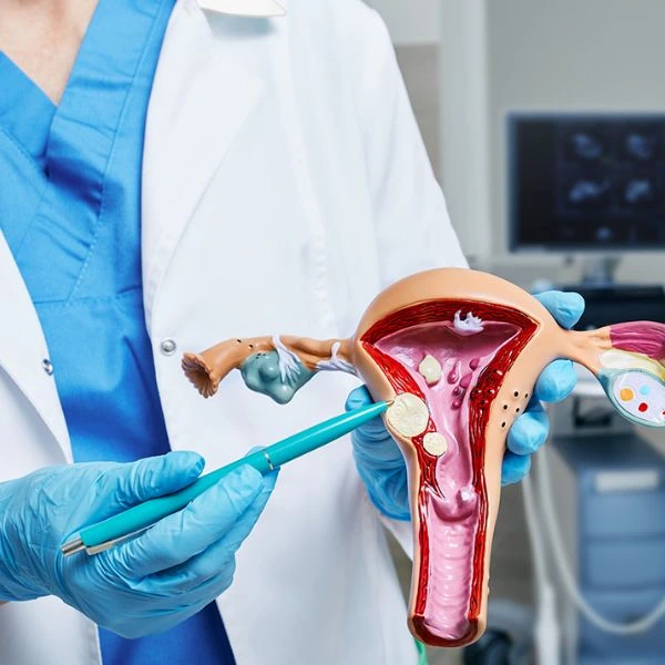 Uterine Fibroids