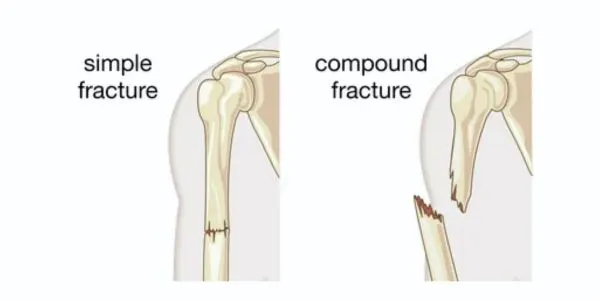 Hairline vs. Compound Fracture: Know the Difference